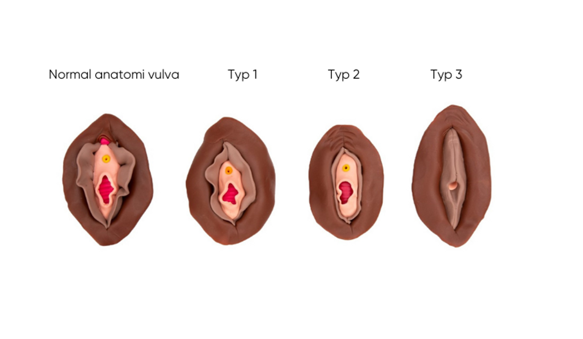lllustratitioner över 4 vulvor vid könsstympning och en normal
